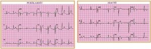perikarditler-ekg-1