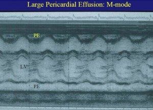 perikarditler-ekg-4