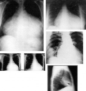 perikarditler-rontgen-2