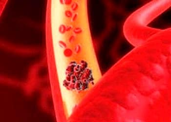 Romatoid artrit hastalarında venöz tromboemboli riski yüksek