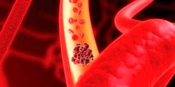 Romatoid artrit hastalarında venöz tromboemboli riski yüksek