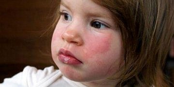 Anafilaksi nedir, tanı ve tedavisi nasıl yapılır?