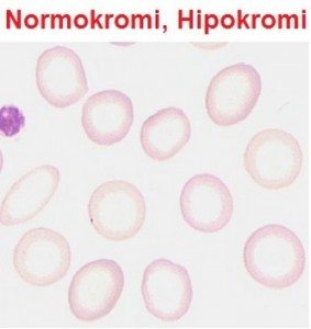demir-eksikligi-anemisi2