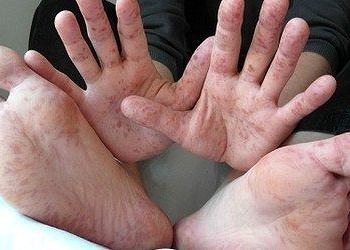 Çin’de El-Ayak-Ağız hastalığına karşı %90 etkili aşı üretildi!