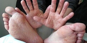 Çin’de El-Ayak-Ağız hastalığına karşı %90 etkili aşı üretildi!