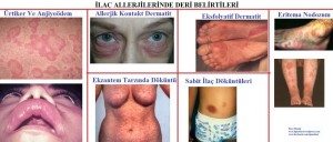 ilac-alerji-advers2