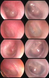 Akut_Otit_ve_iyilesme