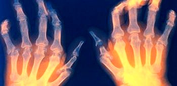 Osteoartrit (OA) belirtileri tanısı ve tedavisi
