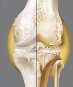 Osteoartrit  nedir medikal akademi