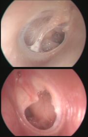 efuzyonlu_otit_tedavi_edilmezse_ne_olur_atilla_sengor