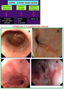 gastroozefagial-reflu-hasta2