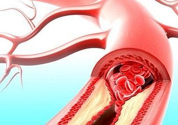 Yüksek kolesterol kontrol altına alınabilir