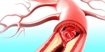 Yüksek kolesterol kontrol altına alınabilir