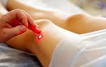 İngiltere varis tedavisinde artık lazeri tercih edecek