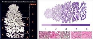 prostat-kanseri1