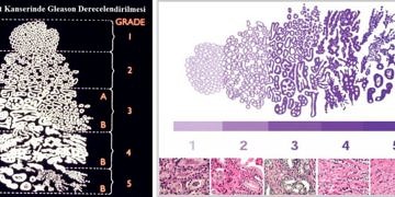 Prostat kanseri tanı ve tedavisi