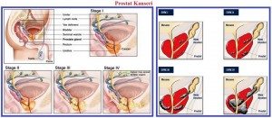 prostat-kanseri2