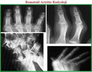 romatoid-artrit-RA3