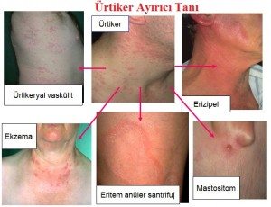 Ürtiker 4 medikala akdemi