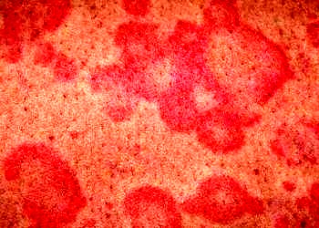 Ürtiker belirtileri tanı ve tedavisi