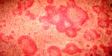 Ürtiker belirtileri tanı ve tedavisi