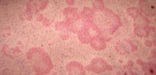 Ürtiker tanı ve tedavisi medikal akademi