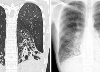 Bronşektazi belirtileri tanı ve tedavisi