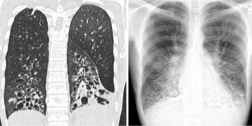 Bronşektazi belirtileri tanı ve tedavisi