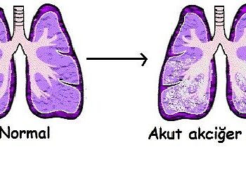 Akut akciğer ödemi tanı ve tedavisi