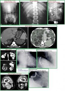bobrek-kalitsal-kistik-hastalik4