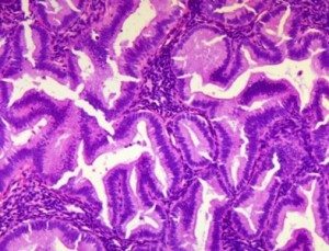 endometrial-hyperplasia