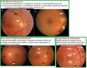 hipertansif retinopati