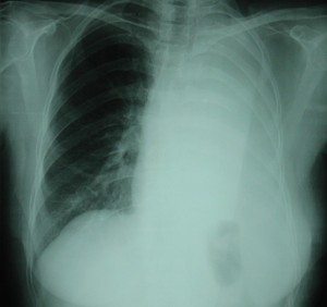Mezotelyoma belirtileri medikala akademi