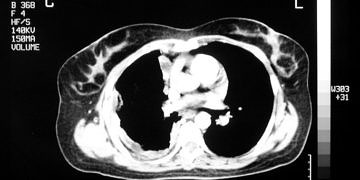 Mezotelyoma tanı ve tedavi yöntemleri