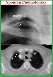 Pnömotoraks1-1 medikal akademi