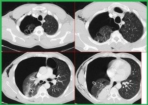 Pnömotoraks1-2 medikal akademi