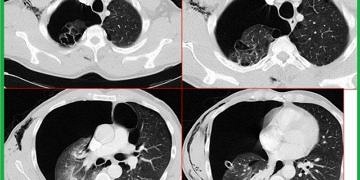 Pnömotoraks tanı ve tedavisi