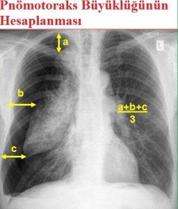 Pnömotoraks1- medikal akademi