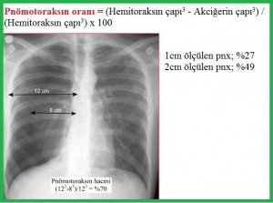 Pnömotoraks2-1.medikal akademi