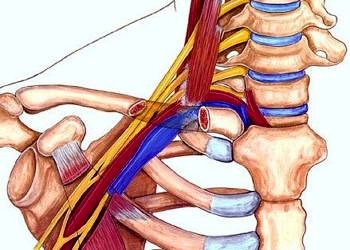 Torasik outlet sendromu tanı ve tedavisi