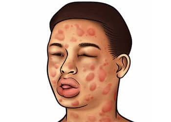 Anafilaksi nedir, tanı ve tedavisi nasıl yapılır?