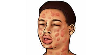 Anafilaksi nedir, tanı ve tedavisi nasıl yapılır?