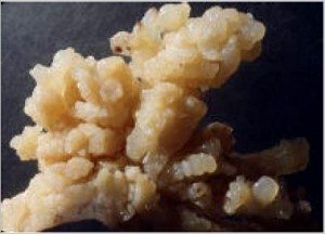 diferansiyel tümör