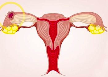 Dış gebelik nedir? Neden olur? Belirtileri ve tedavisi