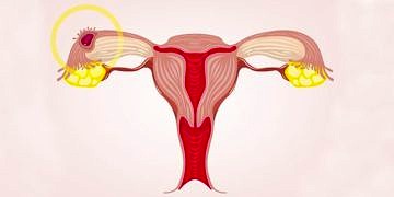 Dış gebelik nedir? Neden olur? Belirtileri ve tedavisi