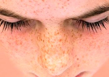 Kenarları düzensiz ve büyük benlere dikkat