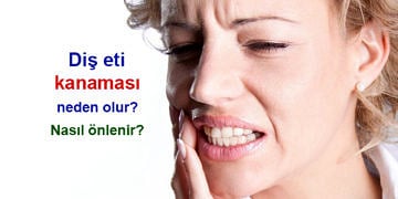 Diş eti kanaması neden olur? Nasıl önlenir? Doğal tedavisi