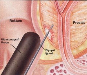 prostat biyopsi