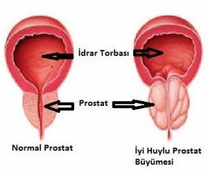 prostat tümörü