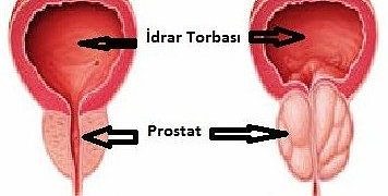 Prostat kanseri tanı ve tedavi rehberi